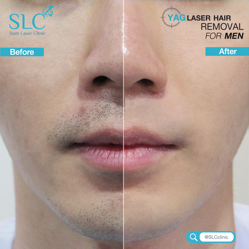 เลเซอร์กำจัดขน_Laser Hair Removal