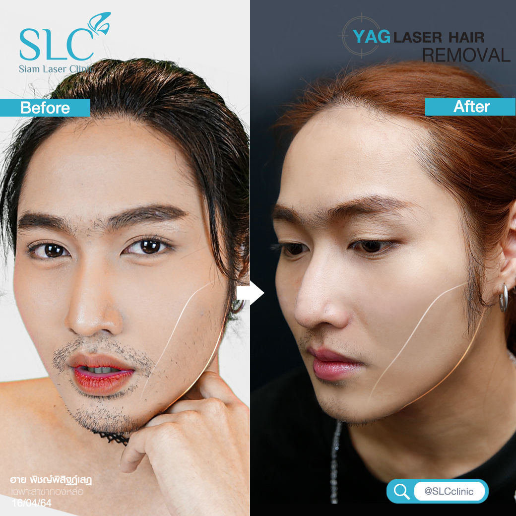 Hair Laser Removal_เลเซอร์ขน กำจัดขน