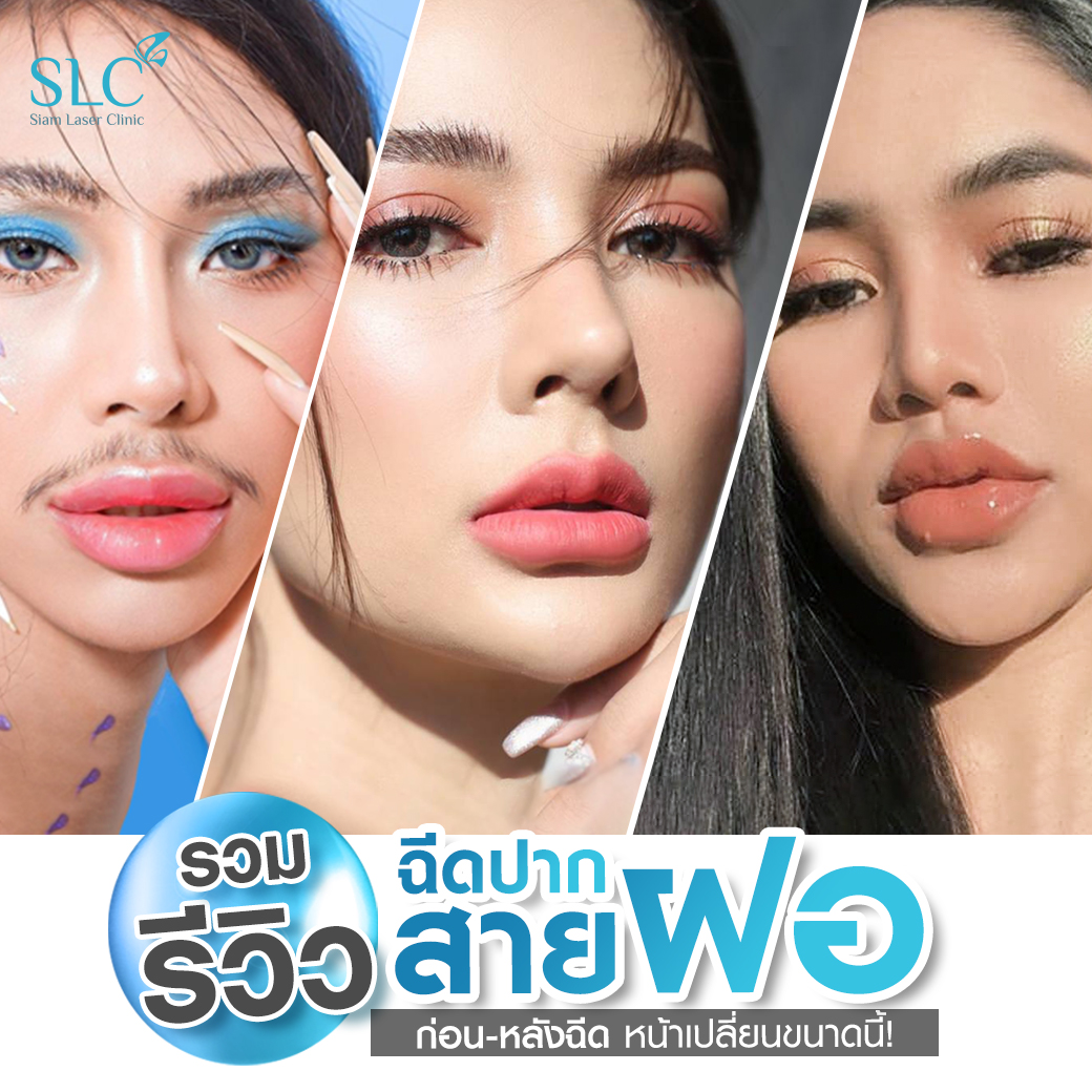 ฉีดปาก_ฟิลเลอร์ปาก_Filler Lip