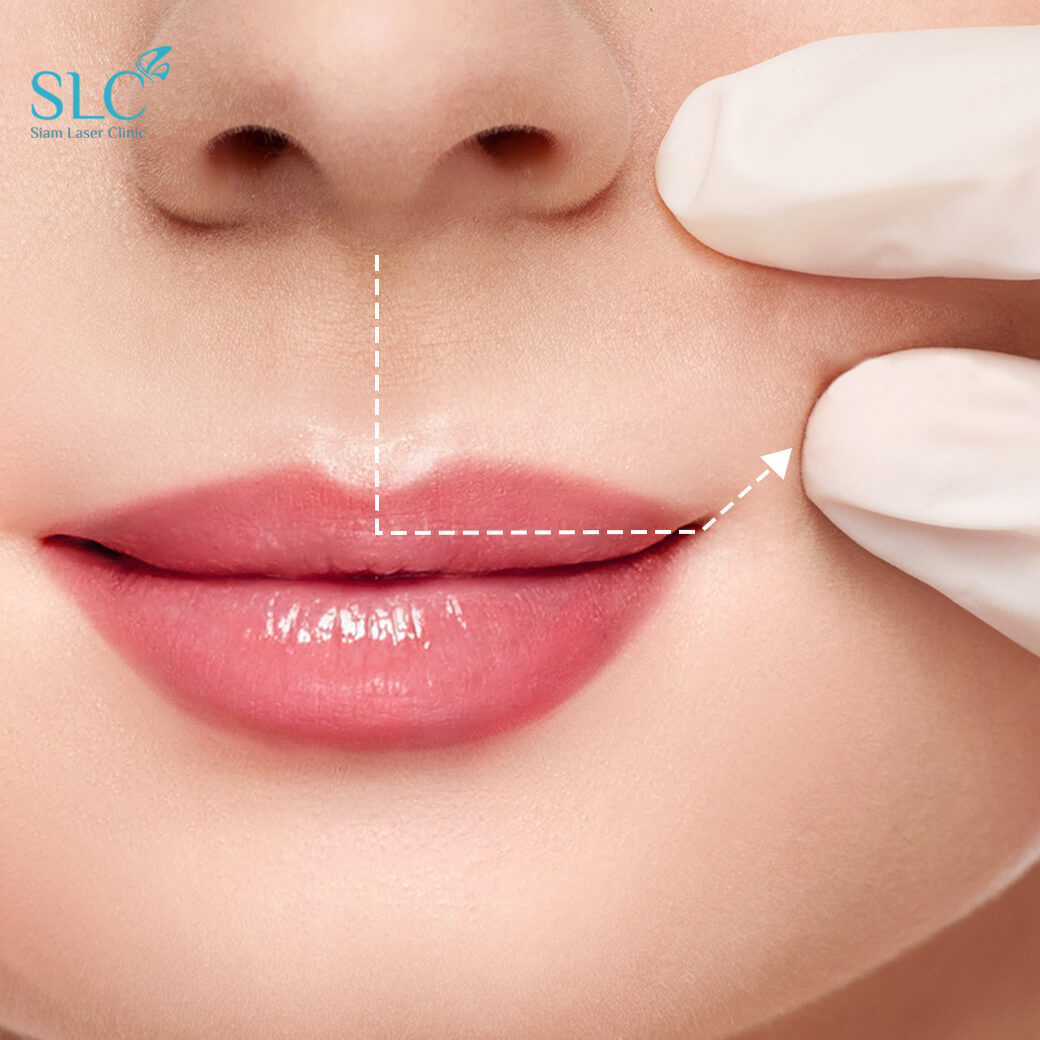 ฉีดปาก_ฟิลเลอร์_Filler Lip_ลำไย ไหทองคำ_ฉีดสารเติมเต็ม_ฉีดขมับ_ฉีดร่องแก้ม