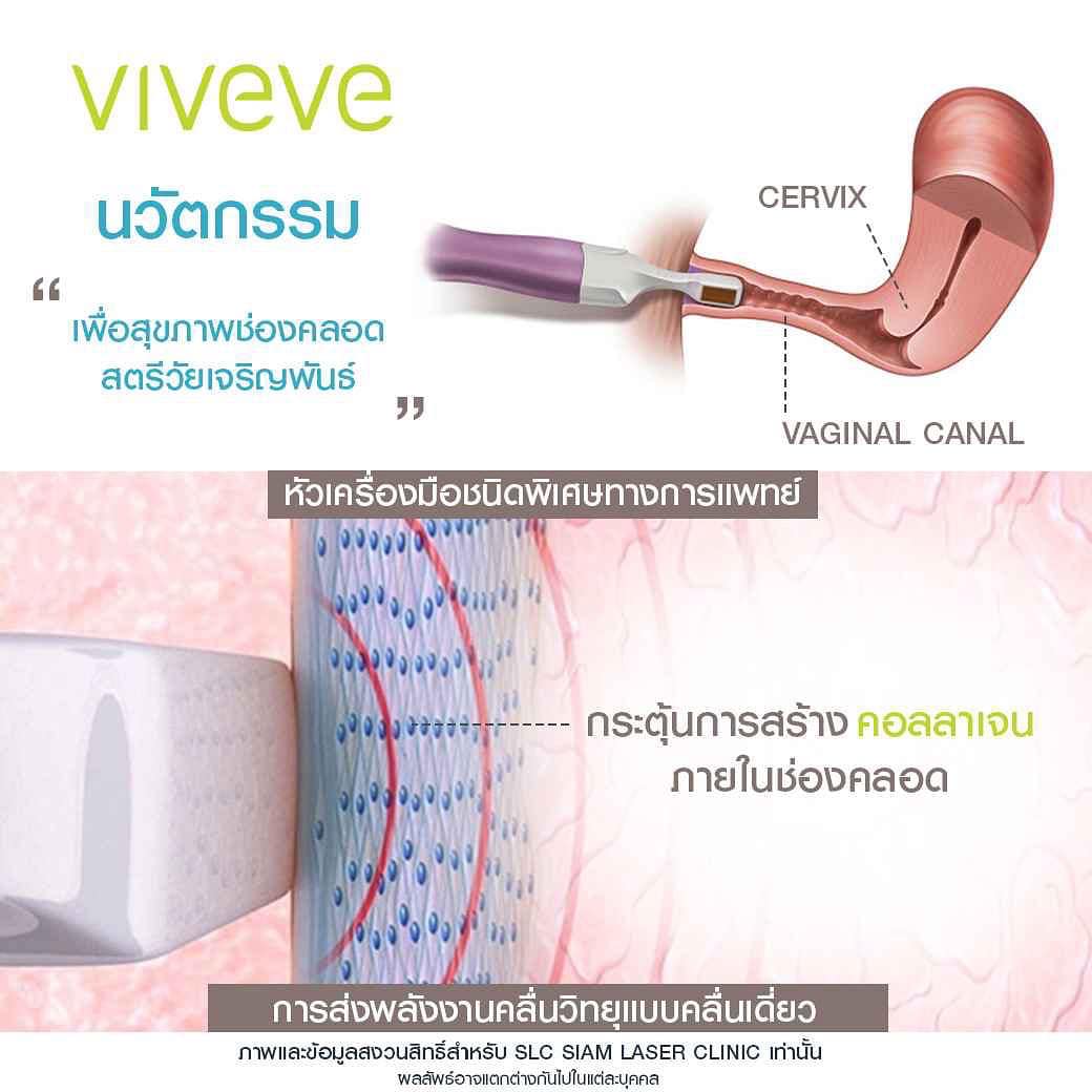 กระชับช่อคลอด_คุณแม่หลังคลอด_viveve_vaginy