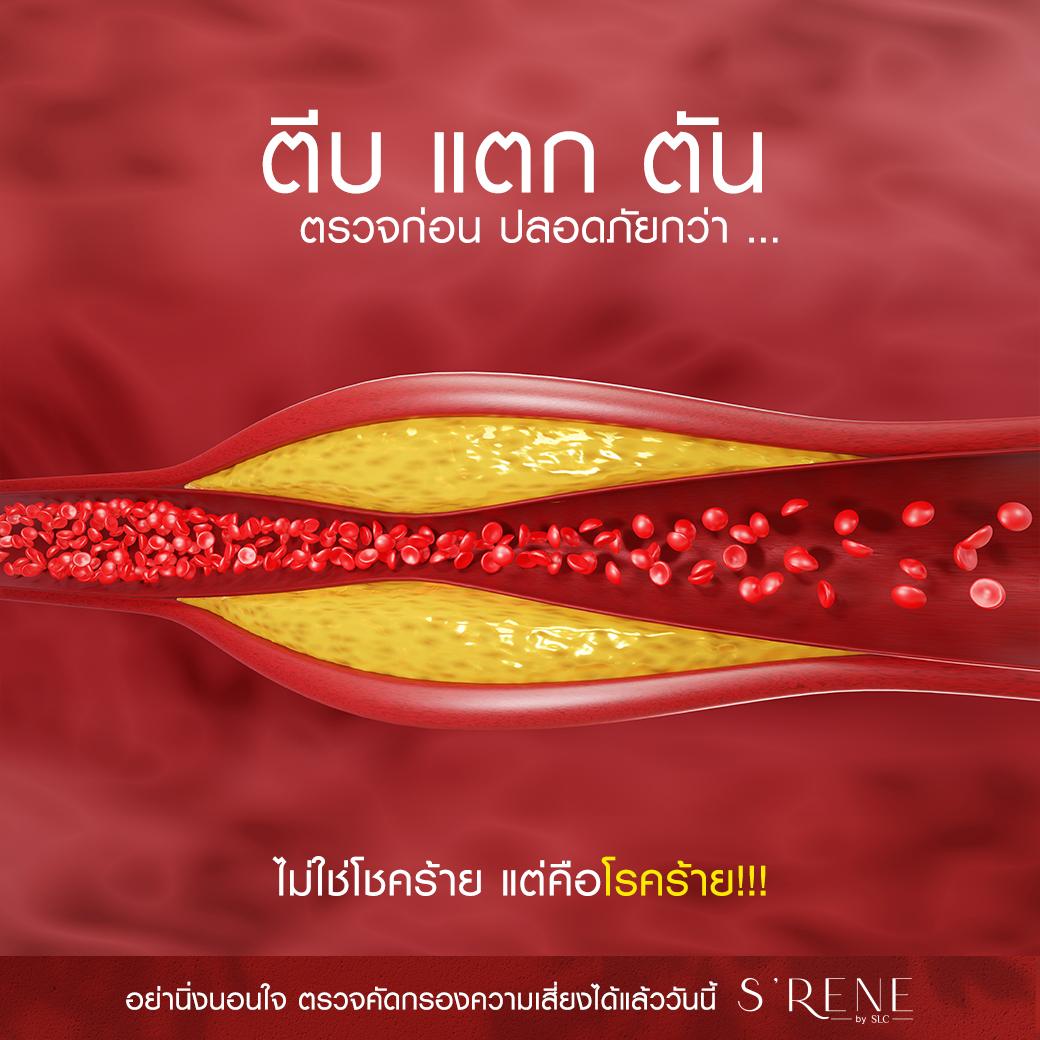 หลอดเลือดสมองตีบ,หลอดเลือดหัวใจตีบ,อาการ stroke,หลอดเลือดหัวใจตีบ อาการ,อายุหลอดเลือด,ตรวจอายุหลอดเลือด,ตรวจหลอดเลือด,เครื่อง ABI,อาการหลอดเลือดหัวใจตีบ,อาการหลอดเลือดสมองตีบ,stroke อาการ,s'rene by slc,s'rene,คลินิกสุขภาพ,คลินิกดูแลสุขภาพ,เวลเนส,wellness