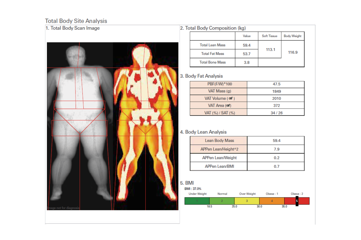 DEXA SCAN SRENE BY SLC 