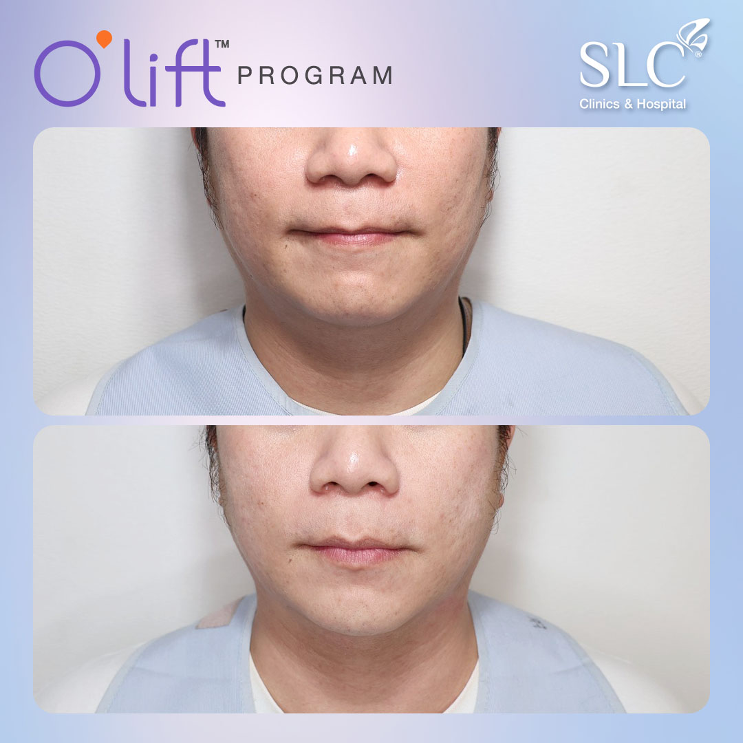 O'lift™ Program, หน้าเรียว, ลดเหนียง