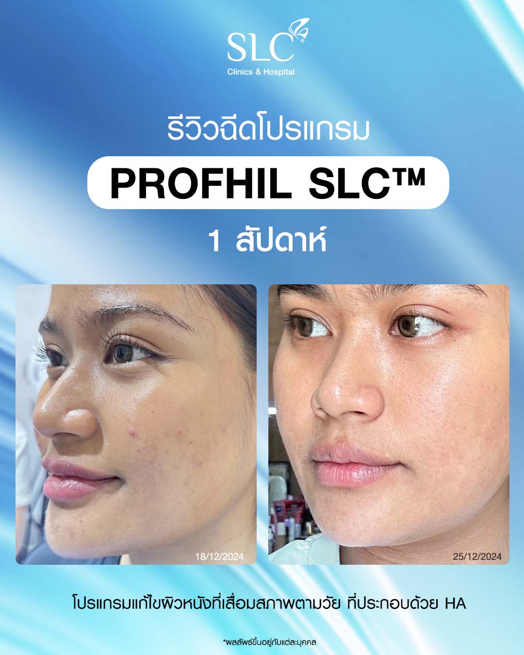 Profile Your Skin, รักษาสิว, รักษาสิวทำยังไง, ProfhilSLC