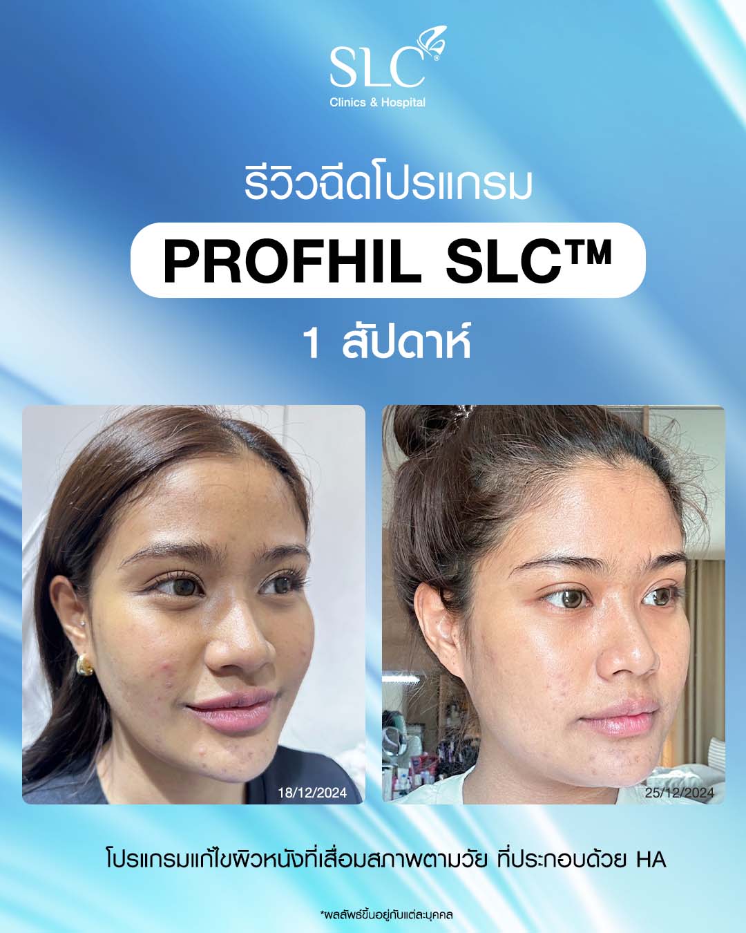 Profile Your Skin, รักษาสิว, รักษาสิวทำยังไง, ProfhilSLC