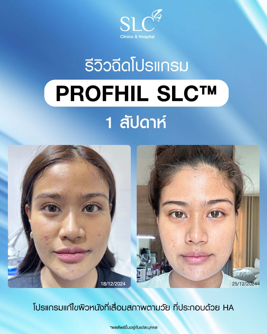 Profile Your Skin, รักษาสิว, รักษาสิวทำยังไง, ProfhilSLC