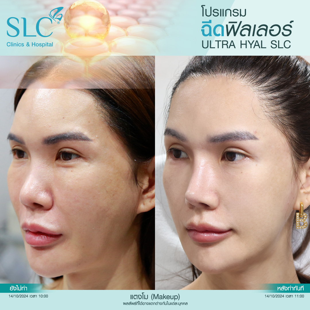 Hyal filler คืออะไร, hyaluron filler, filler hyaluronic acid, ultra v hyal filler, hya filler คือ, รีวิว Hyal filler, Hyal filler ช่วยอะไร,  Hyal filler 