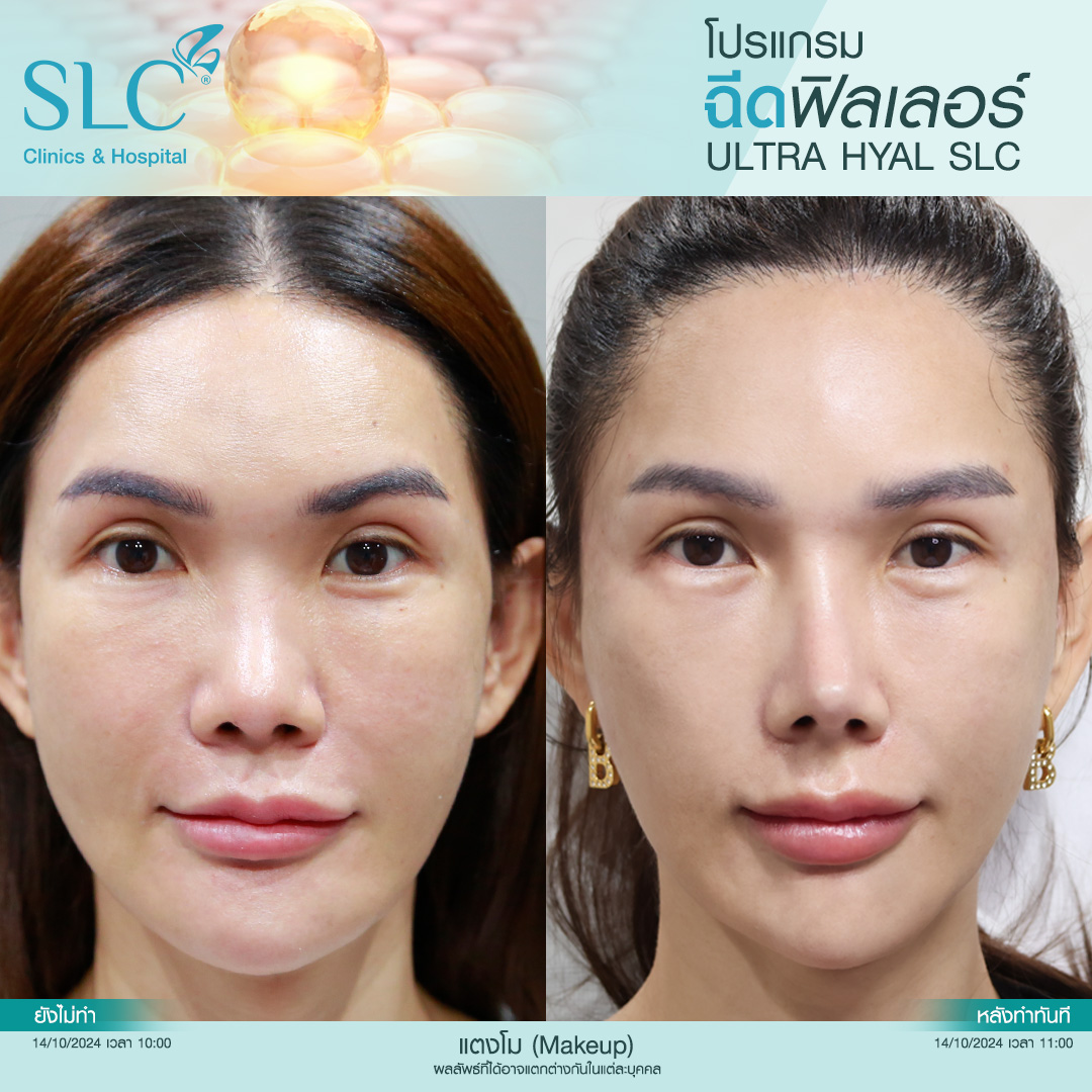 Hyal filler คืออะไร, hyaluron filler, filler hyaluronic acid, ultra v hyal filler, hya filler คือ, รีวิว Hyal filler, Hyal filler ช่วยอะไร,  Hyal filler 