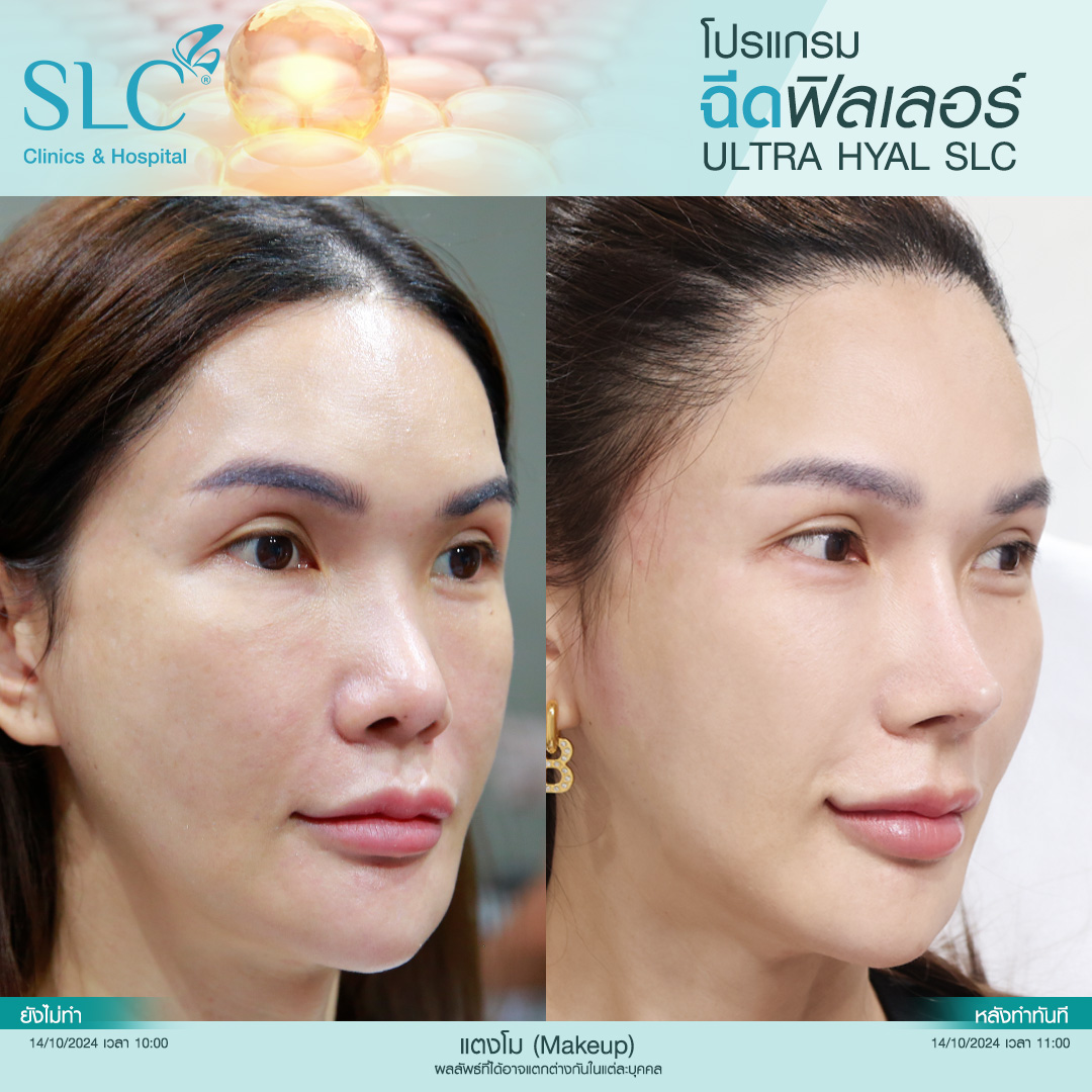 Hyal filler คืออะไร, hyaluron filler, filler hyaluronic acid, ultra v hyal filler, hya filler คือ, รีวิว Hyal filler, Hyal filler ช่วยอะไร,  Hyal filler 