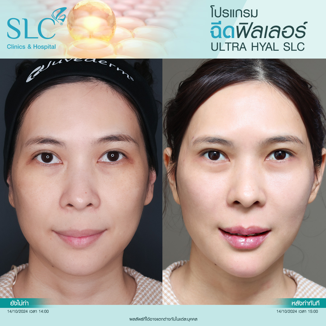 Hyal filler คืออะไร, hyaluron filler, filler hyaluronic acid, ultra v hyal filler, hya filler คือ, รีวิว Hyal filler, Hyal filler ช่วยอะไร,  Hyal filler 
