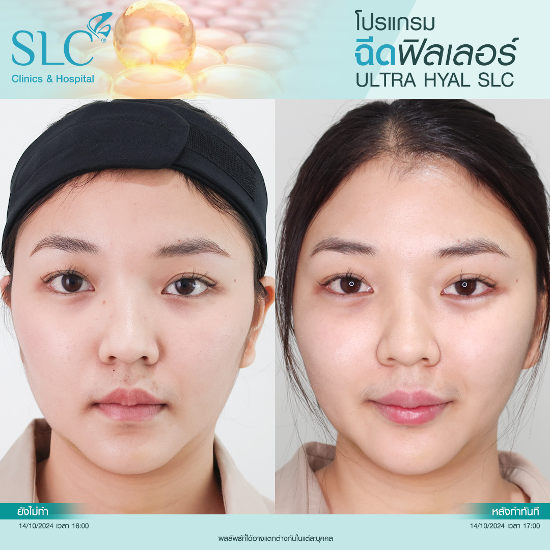 Hyal filler คืออะไร, hyaluron filler, filler hyaluronic acid, ultra v hyal filler, hya filler คือ, รีวิว Hyal filler, Hyal filler ช่วยอะไร,  Hyal filler 
