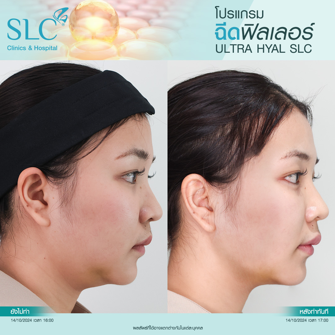 Hyal filler คืออะไร, hyaluron filler, filler hyaluronic acid, ultra v hyal filler, hya filler คือ, รีวิว Hyal filler, Hyal filler ช่วยอะไร,  Hyal filler 