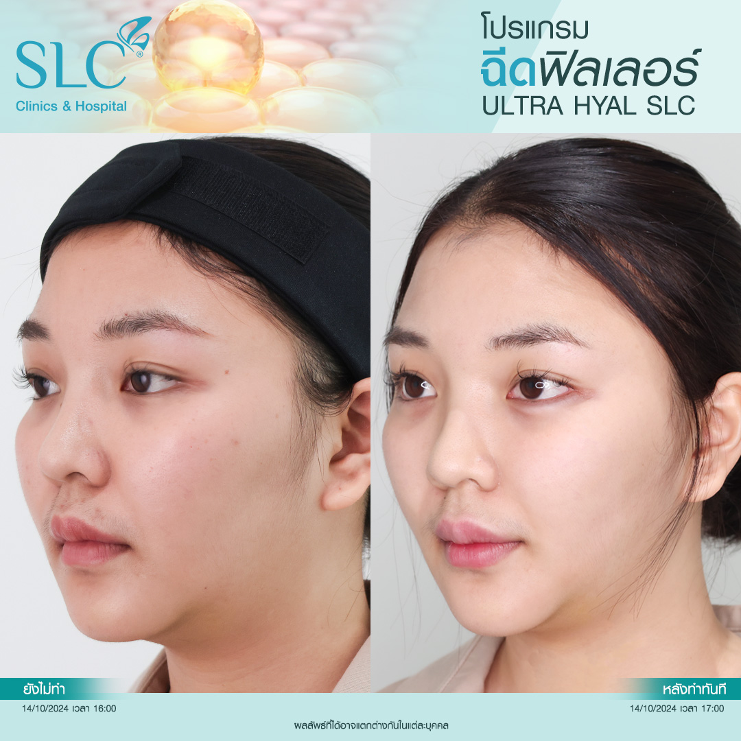 Hyal filler คืออะไร, hyaluron filler, filler hyaluronic acid, ultra v hyal filler, hya filler คือ, รีวิว Hyal filler, Hyal filler ช่วยอะไร,  Hyal filler 