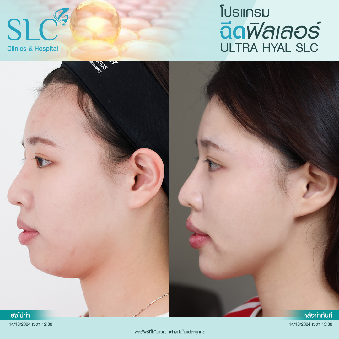 Hyal filler คืออะไร, hyaluron filler, filler hyaluronic acid, ultra v hyal filler, hya filler คือ, รีวิว Hyal filler, Hyal filler ช่วยอะไร,  Hyal filler 