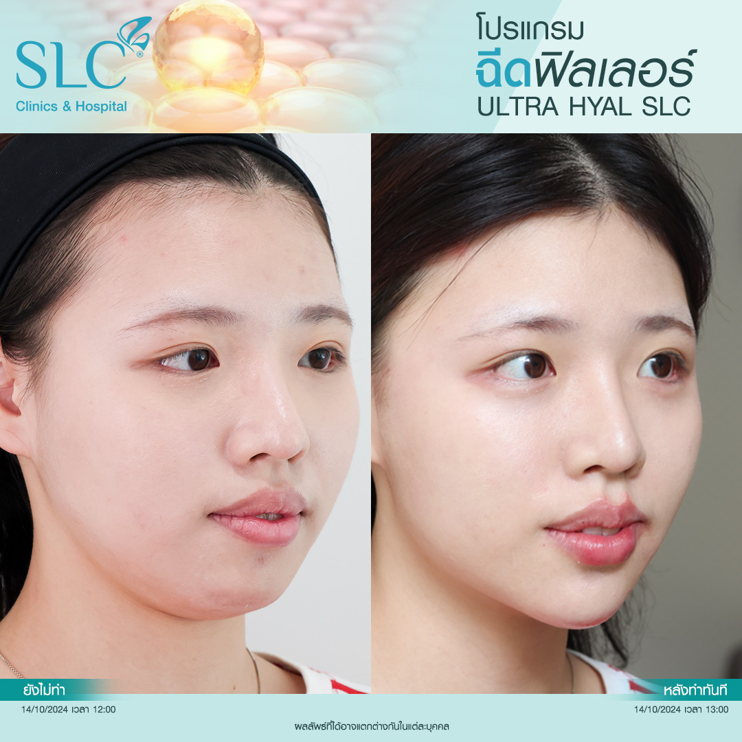 Hyal filler คืออะไร, hyaluron filler, filler hyaluronic acid, ultra v hyal filler, hya filler คือ, รีวิว Hyal filler, Hyal filler ช่วยอะไร,  Hyal filler 