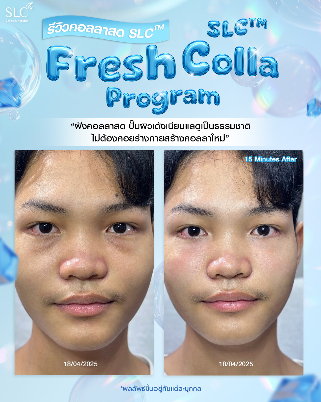  Fresh Colla SLC, Collaju, คอลลาสด SLC, ตัวช่วยกระตุ้นคอลลาเจน