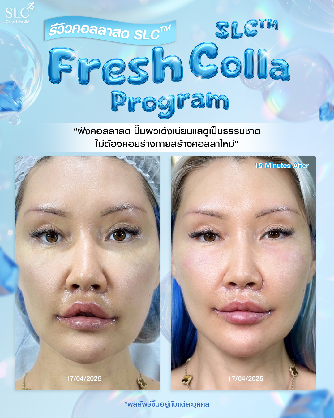  Fresh Colla SLC, Collaju, คอลลาสด SLC, ตัวช่วยกระตุ้นคอลลาเจน