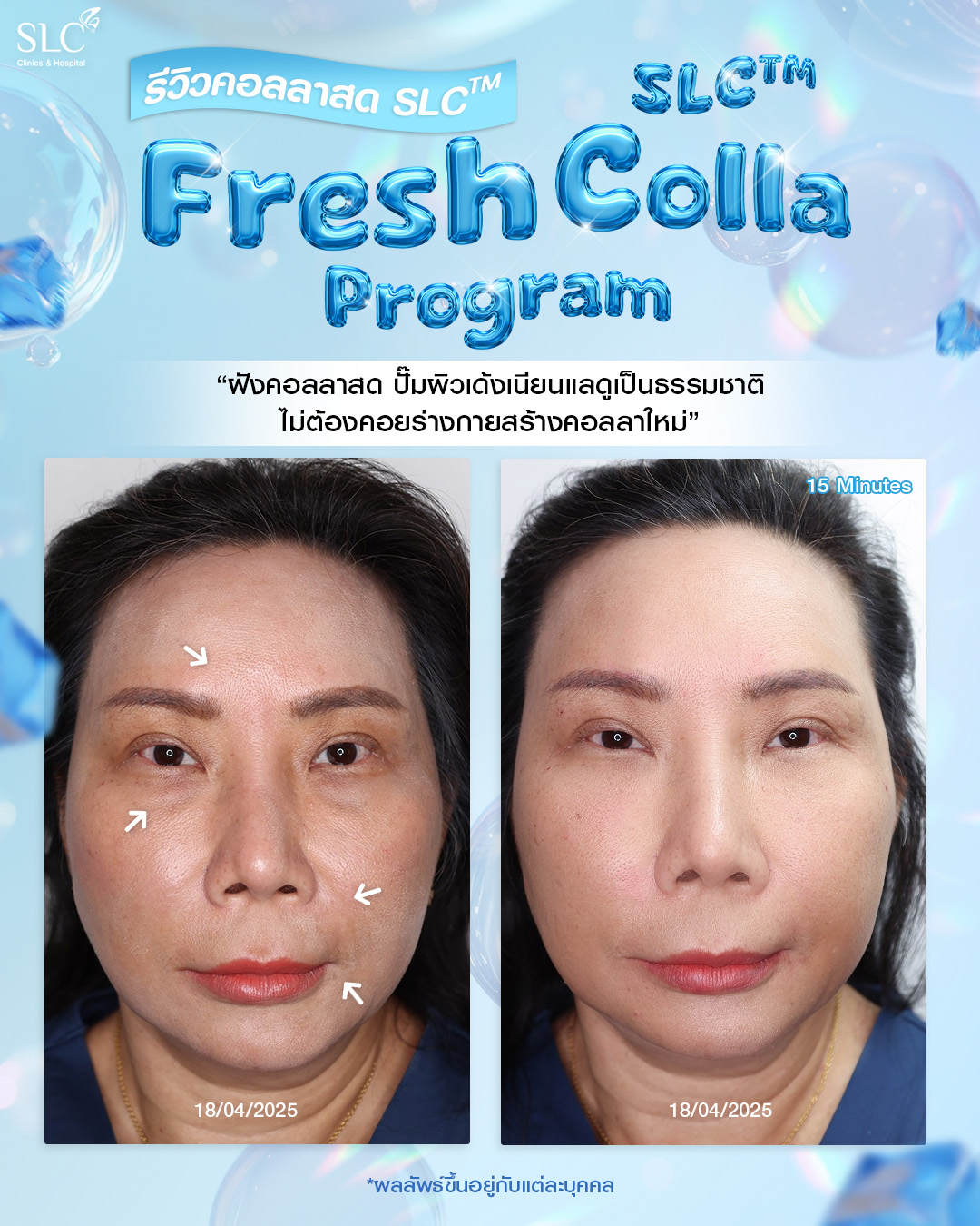  Fresh Colla SLC, Collaju, คอลลาสด SLC, ตัวช่วยกระตุ้นคอลลาเจน