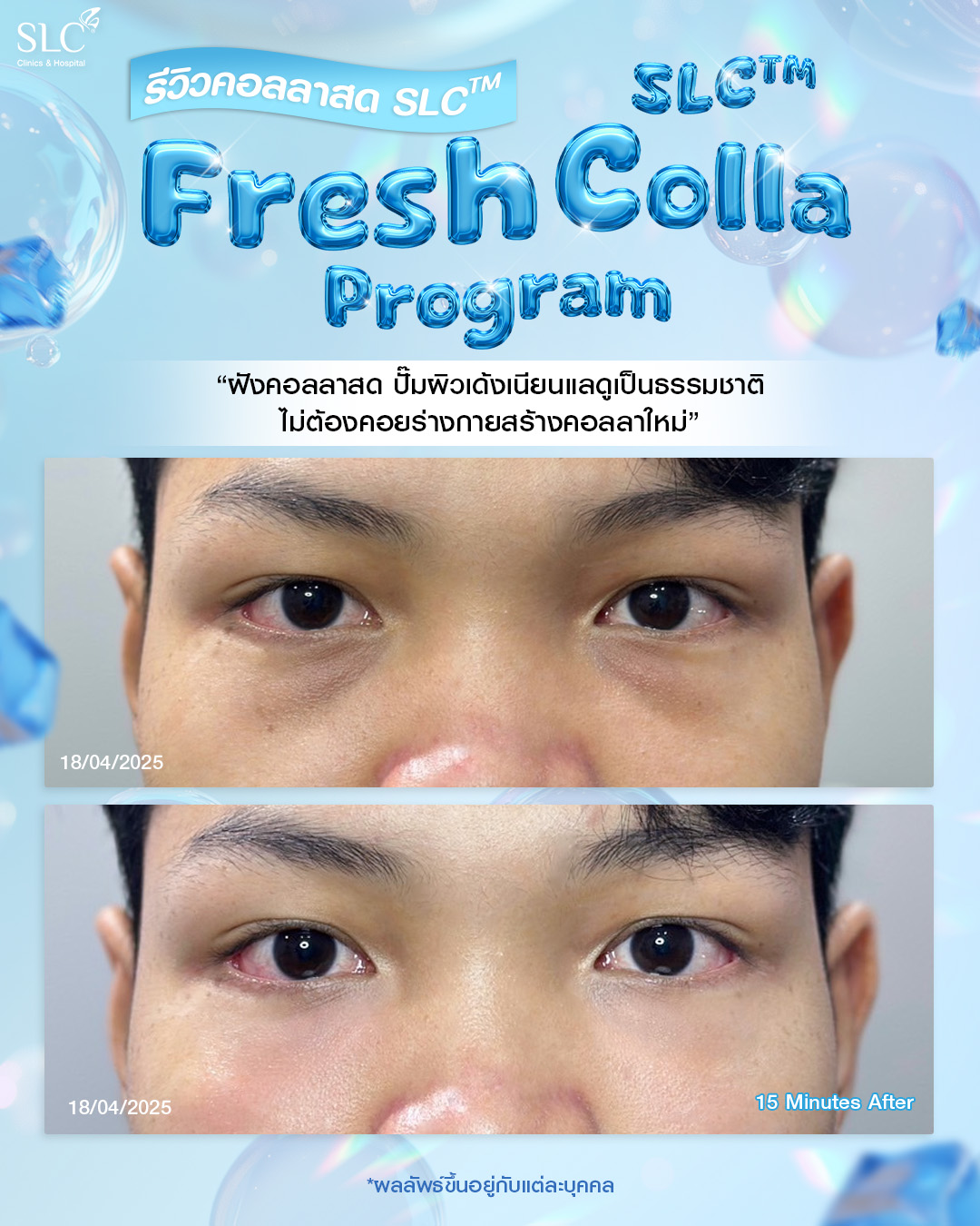  Fresh Colla SLC, Collaju, คอลลาสด SLC, ตัวช่วยกระตุ้นคอลลาเจน