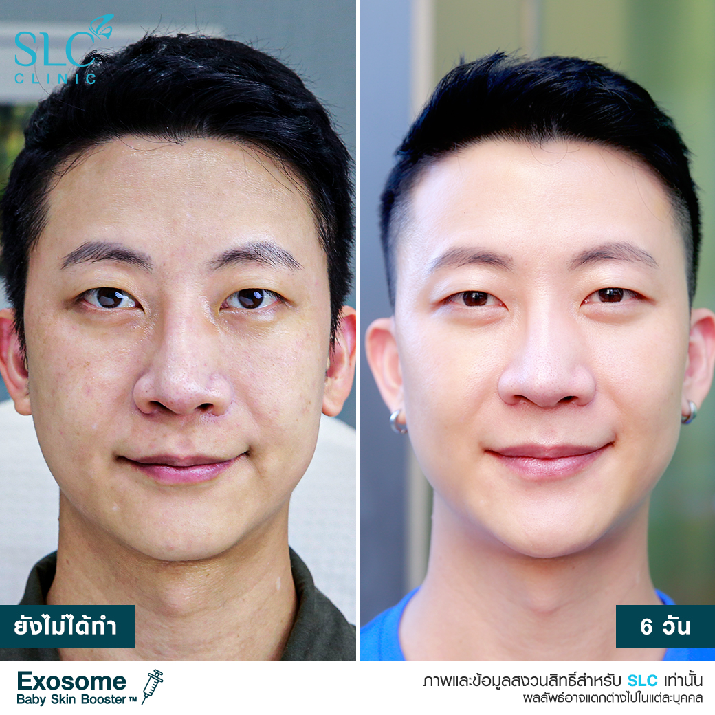 หน้าเนียน หน้าเด็ก รีวิววิตามินบูสต์ผิวเด็ก SLC  Baby Skin Booster วิตามินผิวหน้า เบบี้ สกิน บูสเตอร์