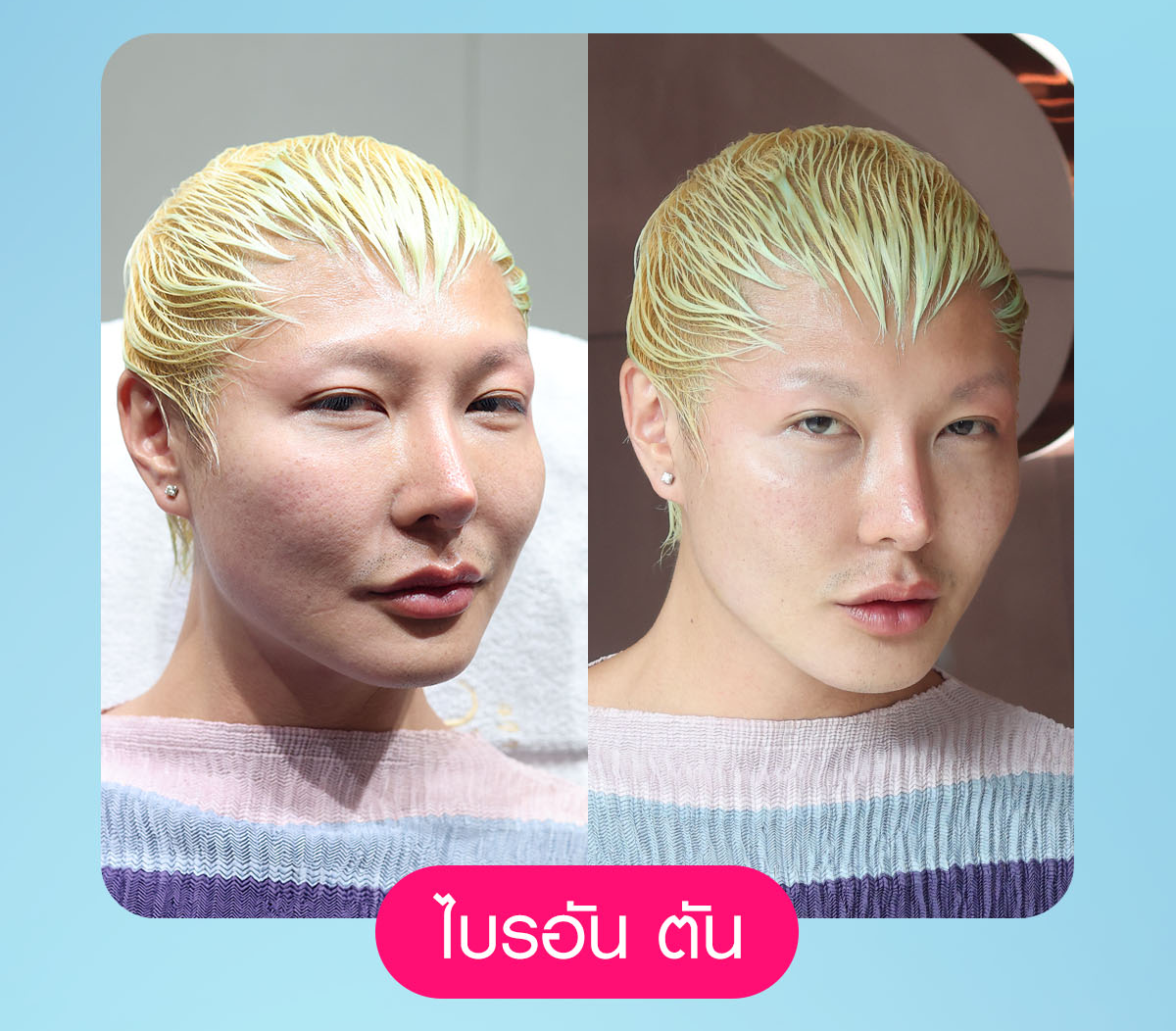 เครื่องยกกระชับ, ยกกระชับใบหน้า, ลดแฟต, ริ้วรอยบนใบหน้า, ลดไขมัน, volnew slc