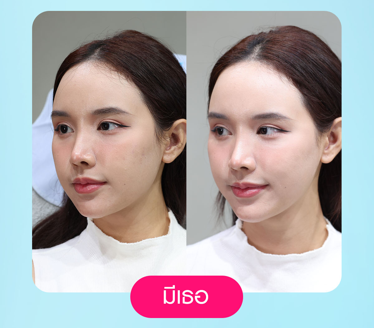 เครื่องยกกระชับ, ยกกระชับใบหน้า, ลดแฟต, ริ้วรอยบนใบหน้า, ลดไขมัน, volnew slc