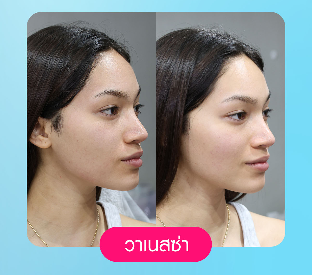 เครื่องยกกระชับ, ยกกระชับใบหน้า, ลดแฟต, ริ้วรอยบนใบหน้า, ลดไขมัน, volnew slc
