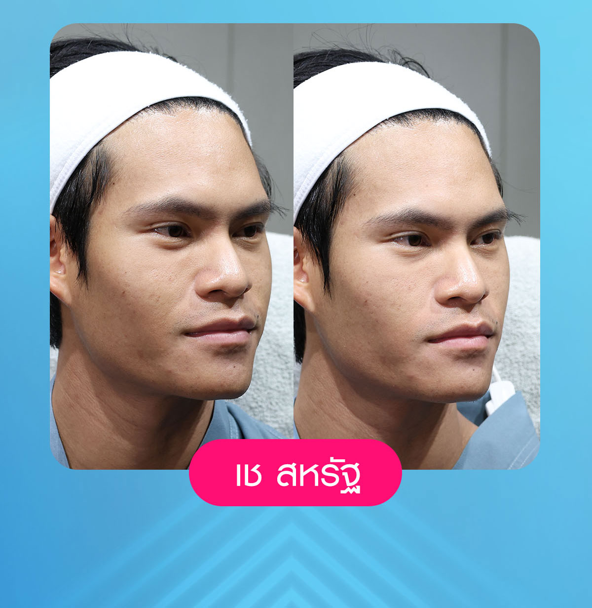 เครื่องยกกระชับ, ยกกระชับใบหน้า, ลดแฟต, ริ้วรอยบนใบหน้า, ลดไขมัน, volnew slc