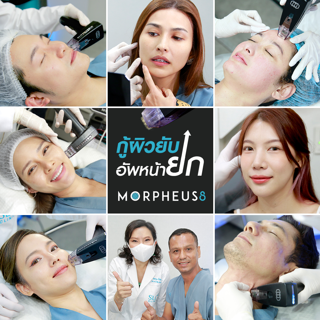 ยกกระชับ Morpheus 8_เขตต์ ฐานทัพ_หน้าเด็ก