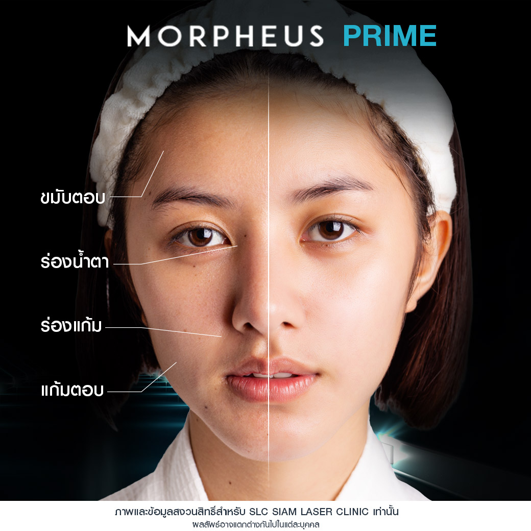Morpheus Prime,ยกกระชับผิว,ยกคิ้ว,ยกหางตา