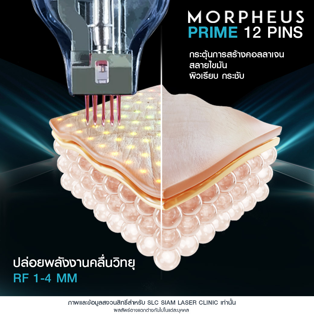 Morpheus Prime,ยกกระชับผิว,ยกคิ้ว,ยกหางตา