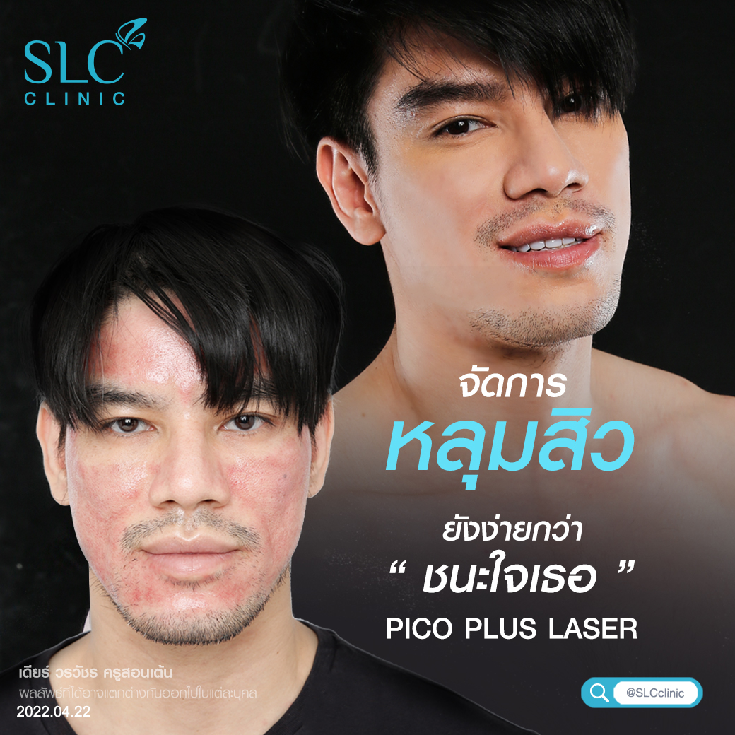 Pico Plus Laser, รีทัชหน้าใส,รักษาหลุมสิว,เลเซอร์หน้าใส,รักษาฝ้า กระ, รักษาสิว,ลบรอยสัก