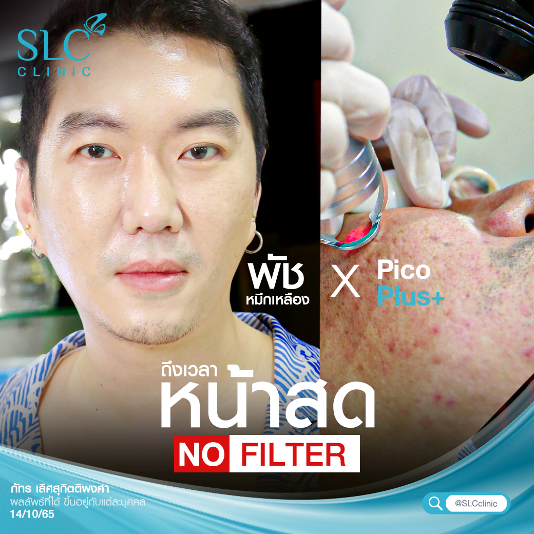 Pico Plus Laser, รีทัชหน้าใส,รักษาหลุมสิว,เลเซอร์หน้าใส,รักษาฝ้า กระ, รักษาสิว,ลบรอยสัก