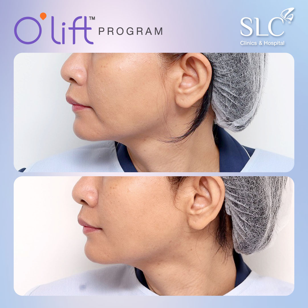 O'lift™ Program, ยกกระชับหน้า