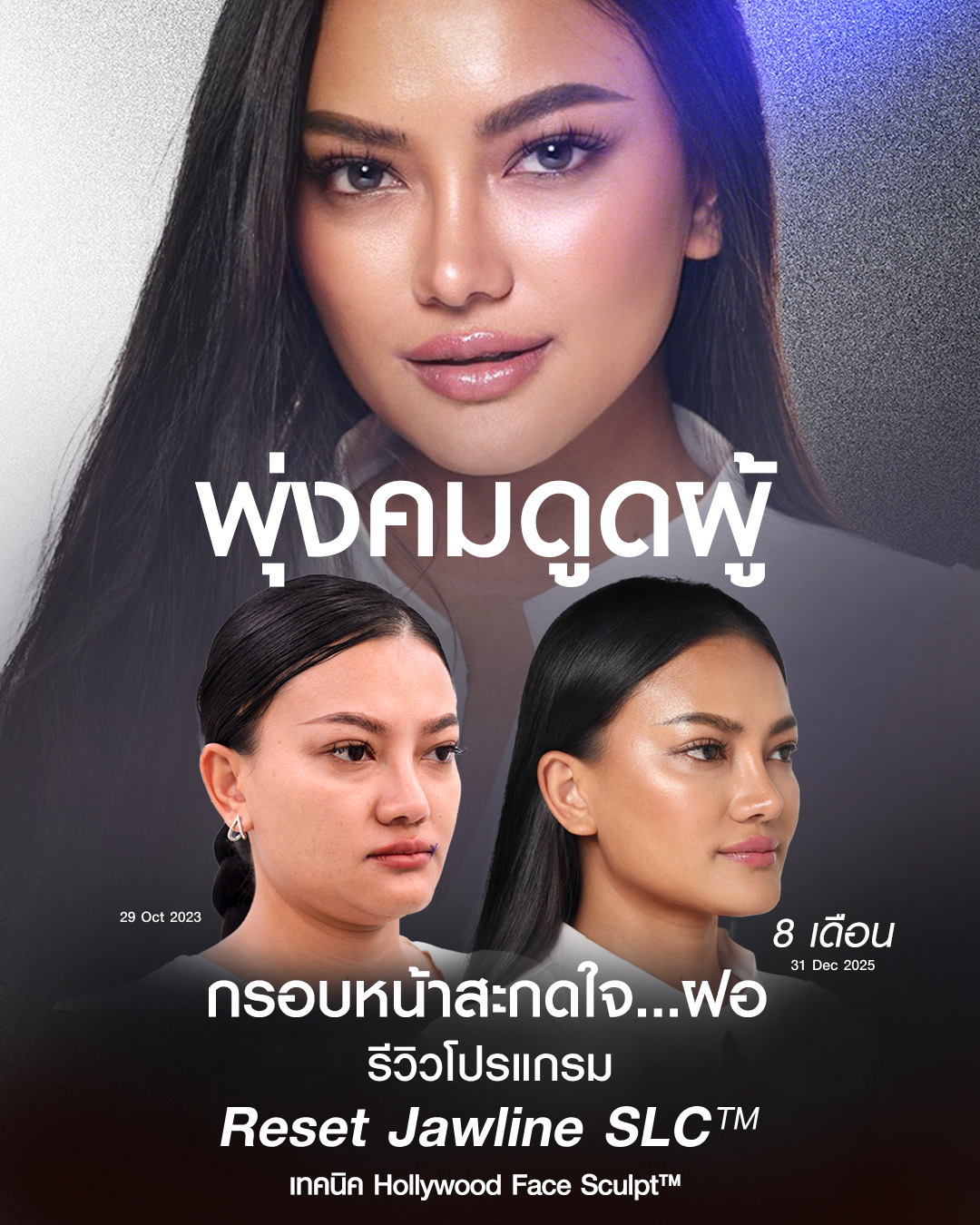Review Radiesse Plus รีวิวเรเดียส พลัส ฉีดกรอบหน้าที่ไหนดี