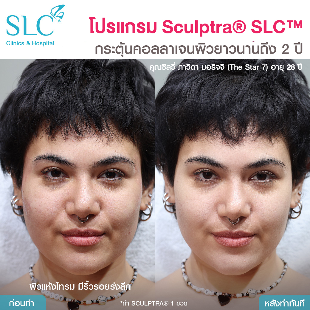 รีวิวสเกาตร้า , Sculptra ดีไหม ? , คุ้มค่าไหม ?