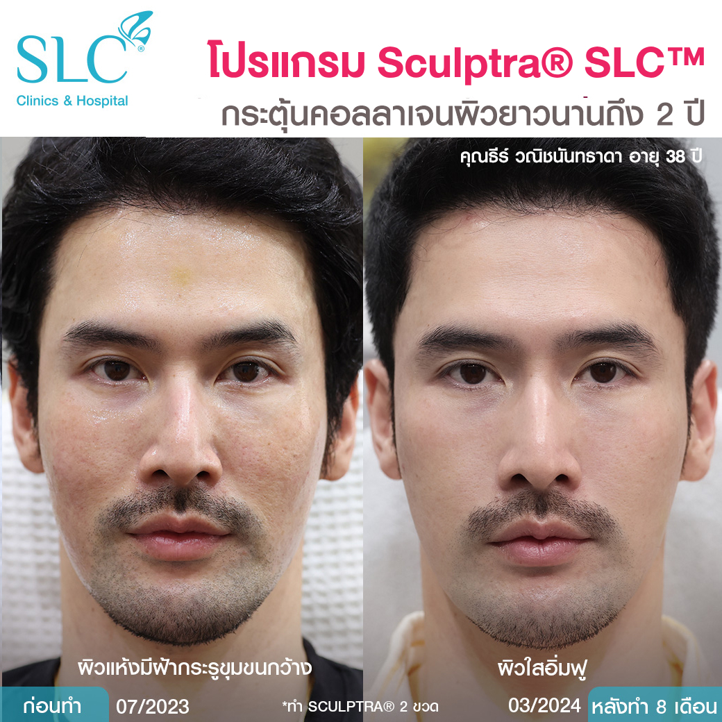Sculptra ดีไหม , รีวิวสเกาตร้า , ฉีดกระตุ้นคอลลาเจนผิว , รีวิว Sculptra