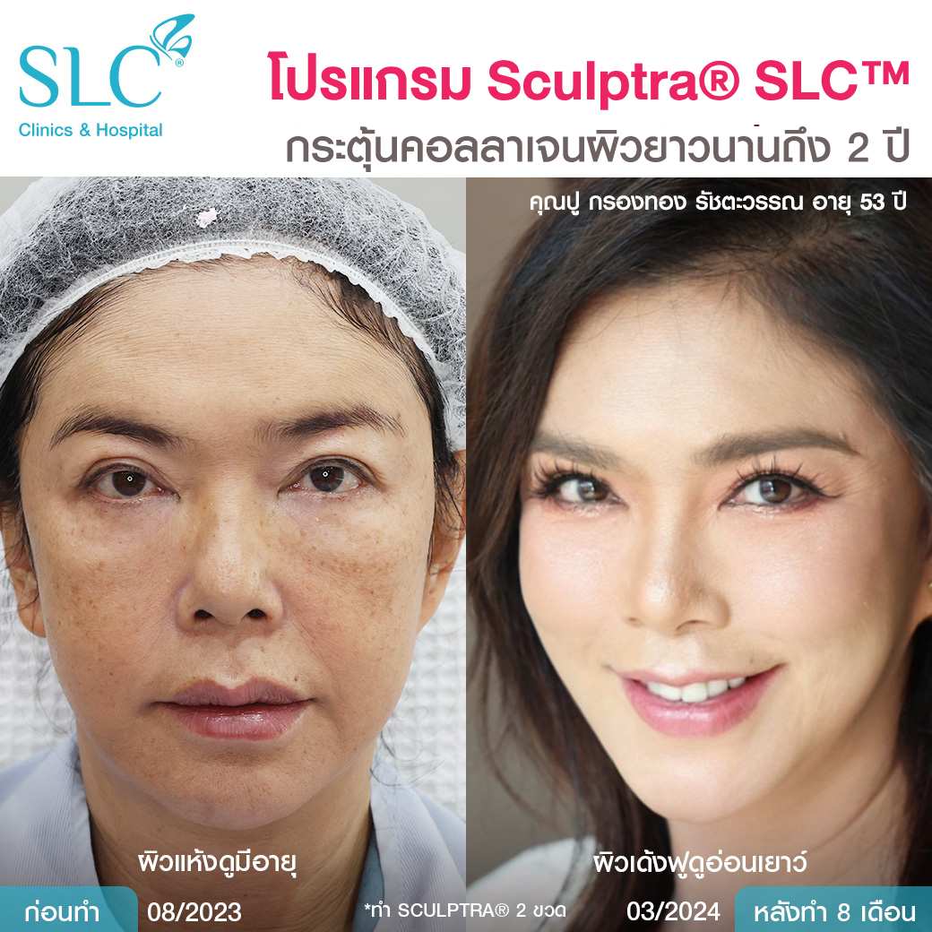 Sculptra ดีไหม , รีวิวสเกาตร้า , ฉีดกระตุ้นคอลลาเจนผิว , รีวิว Sculptra 