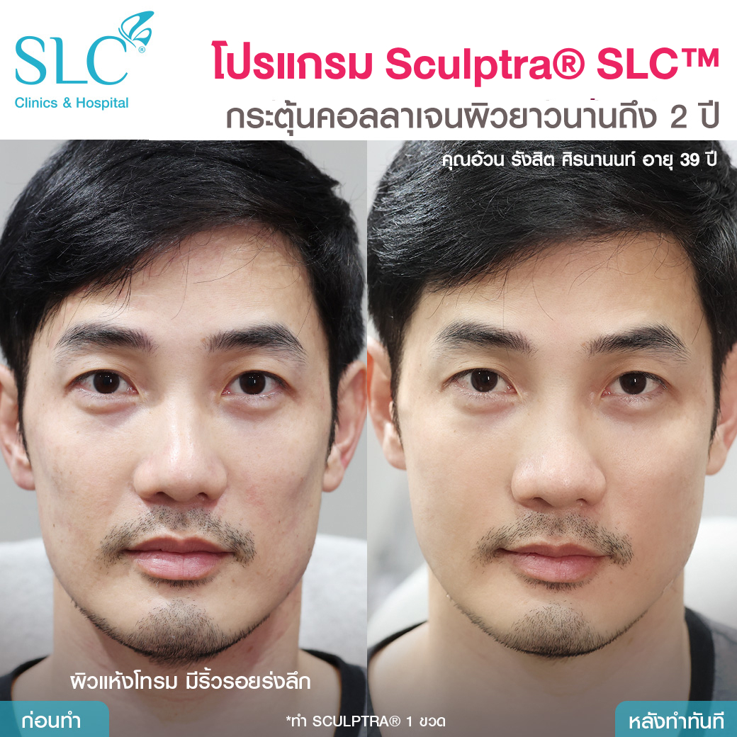 รีวิวสเกาตร้า , Sculptra ดีไหม ? , คุ้มค่าไหม ?