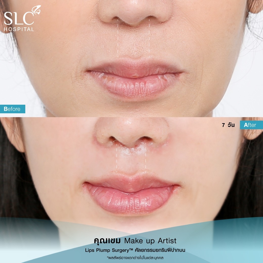 ปากฟู,3D Lips Plump Surgery , ปั้นปากสวย