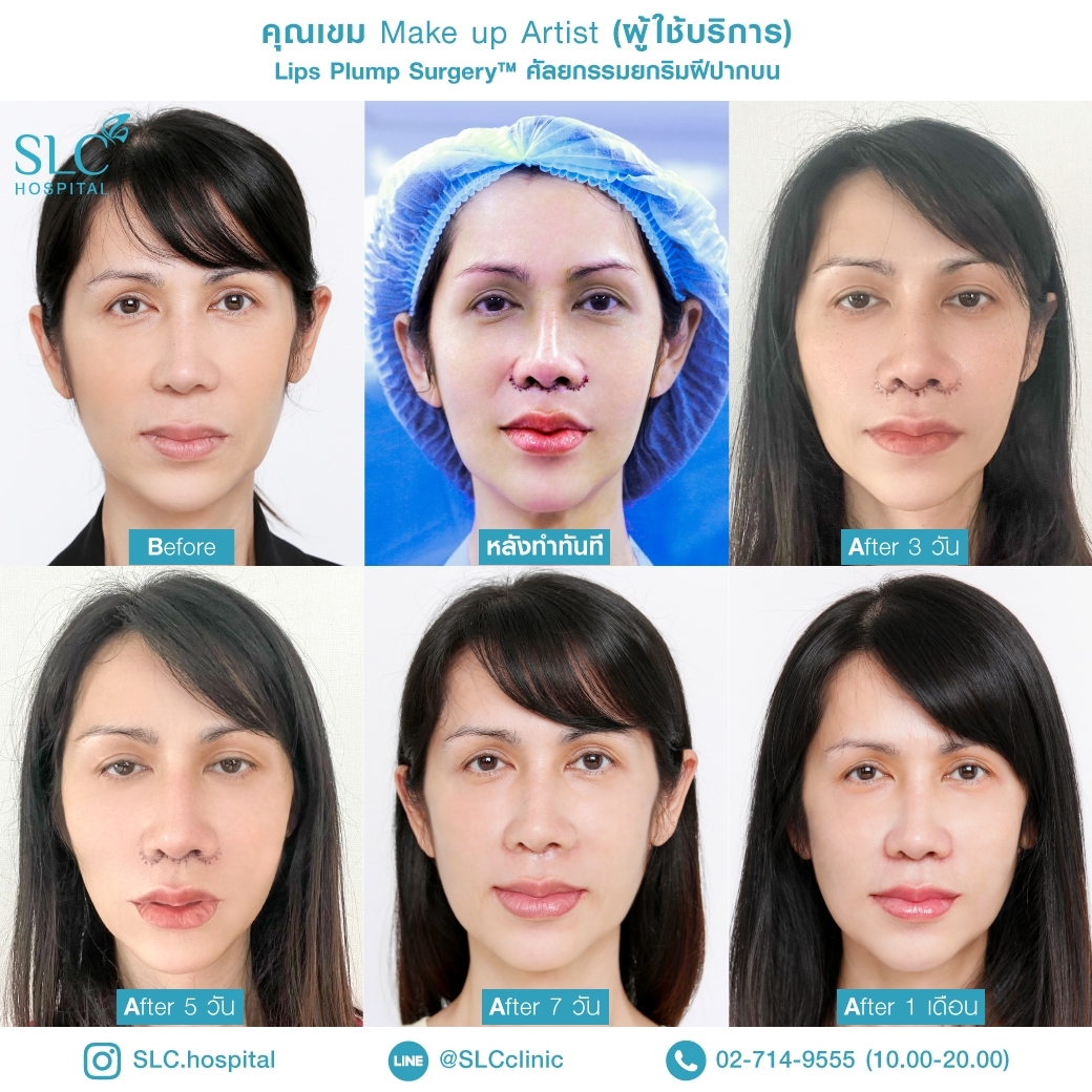 ปากฟู,3D Lips Plump Surgery , ปั้นปากสวย