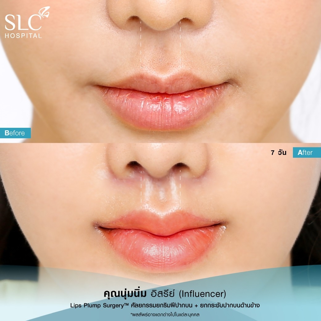 ปากฟู,3D Lips Plump Surgery , ปั้นปากสวย