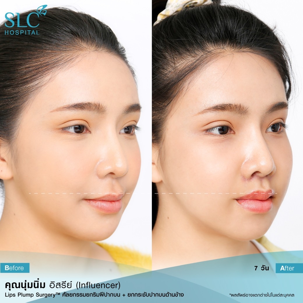 ปากฟู,3D Lips Plump Surgery , ปั้นปากสวย