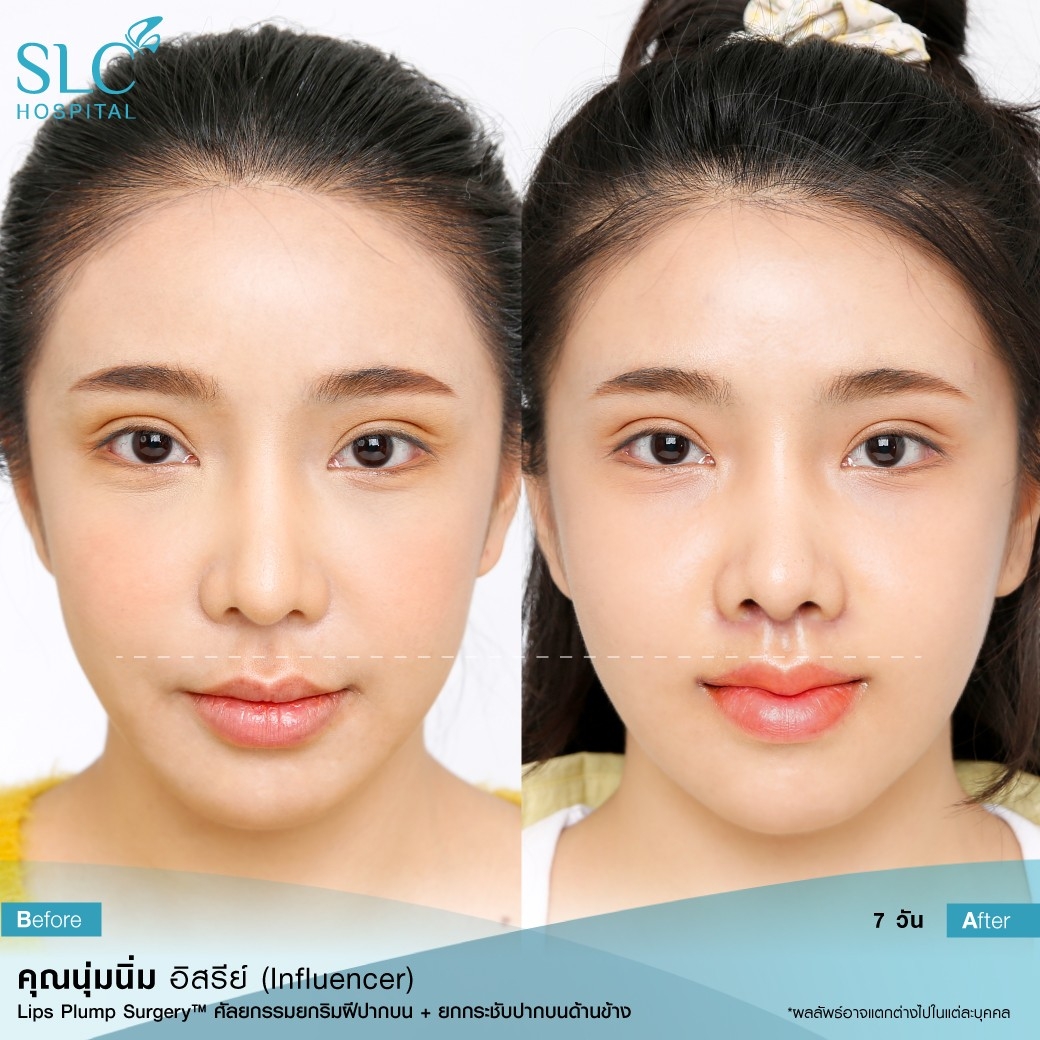 ปากฟู,3D Lips Plump Surgery , ปั้นปากสวย