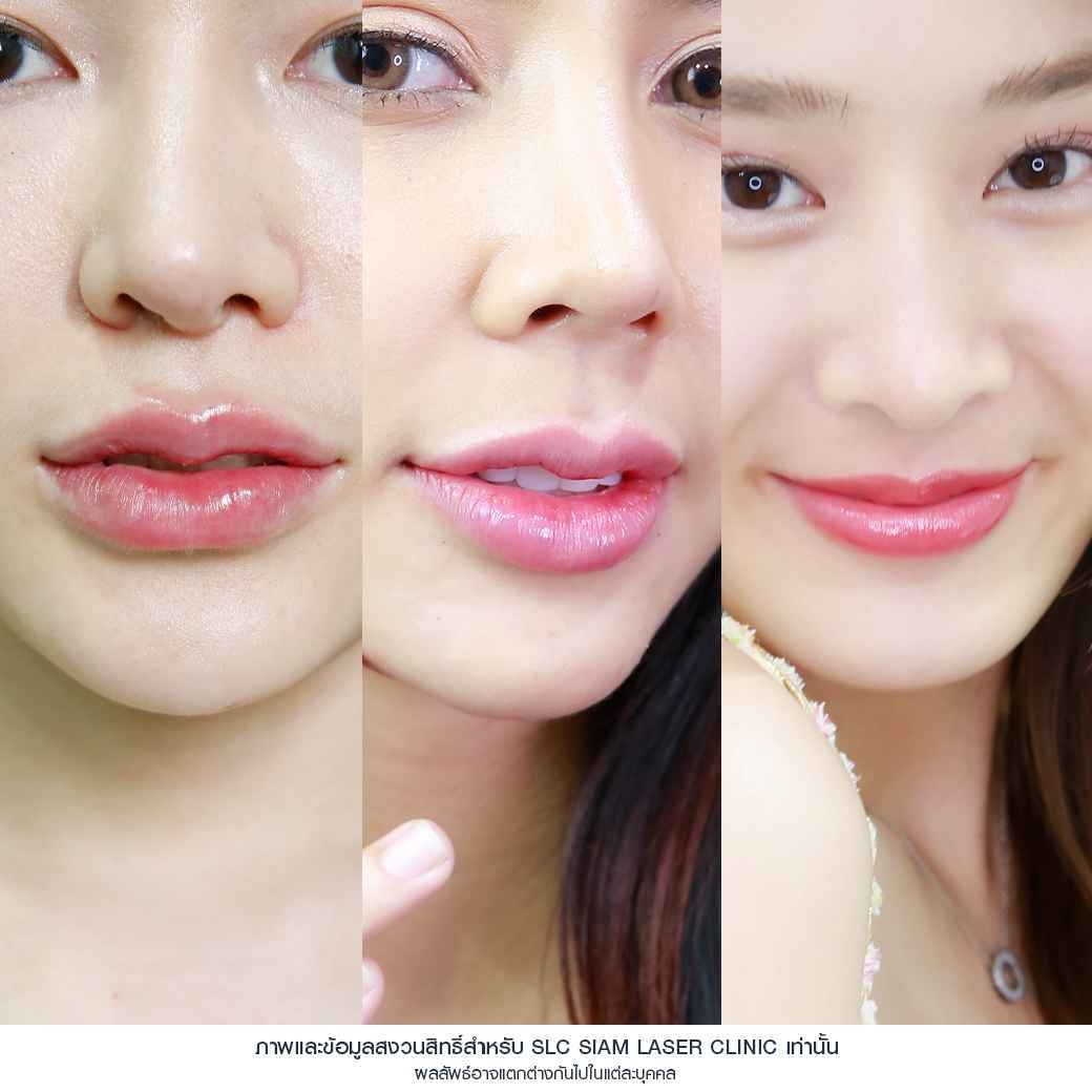 ปากฟู,3D Lips Plump Surgery , ปั้นปากสวย