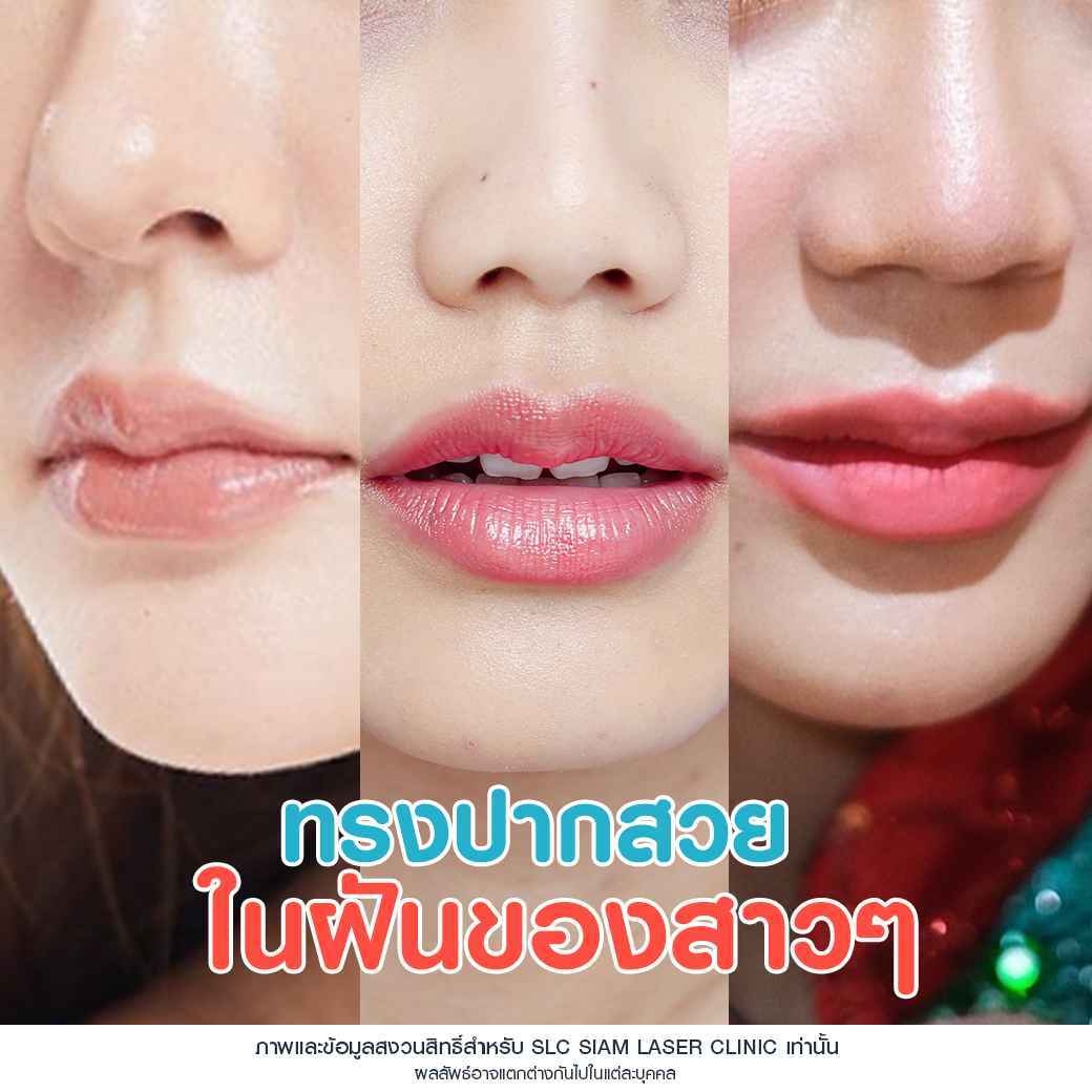 ปากฟู,3D Lips Plump Surgery , ปั้นปากสวย