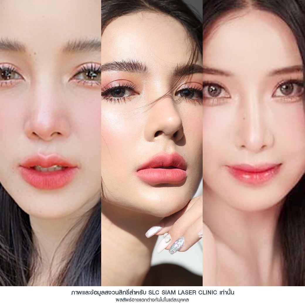 ปากฟู,3D Lips Plump Surgery , ปั้นปากสวย