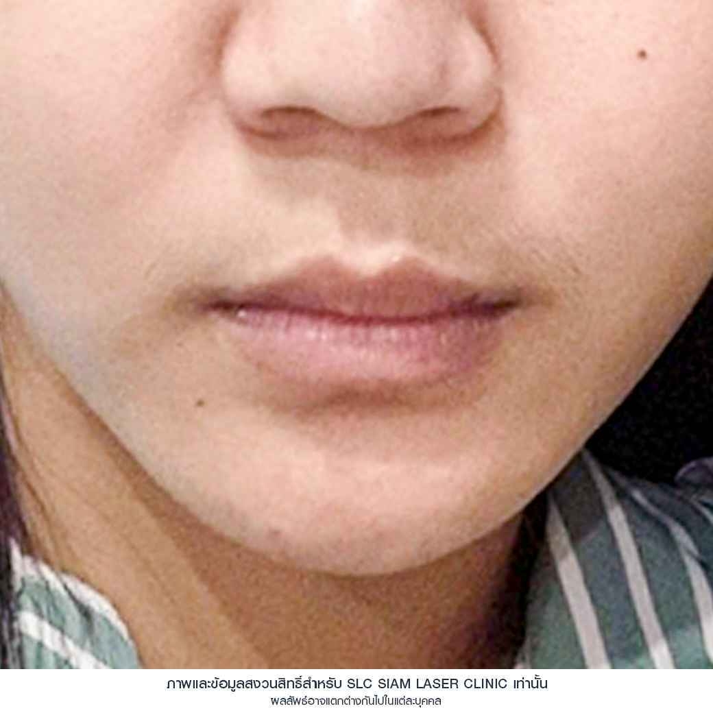 ปากฟู,3D Lips Plump Surgery , ปั้นปากสวย