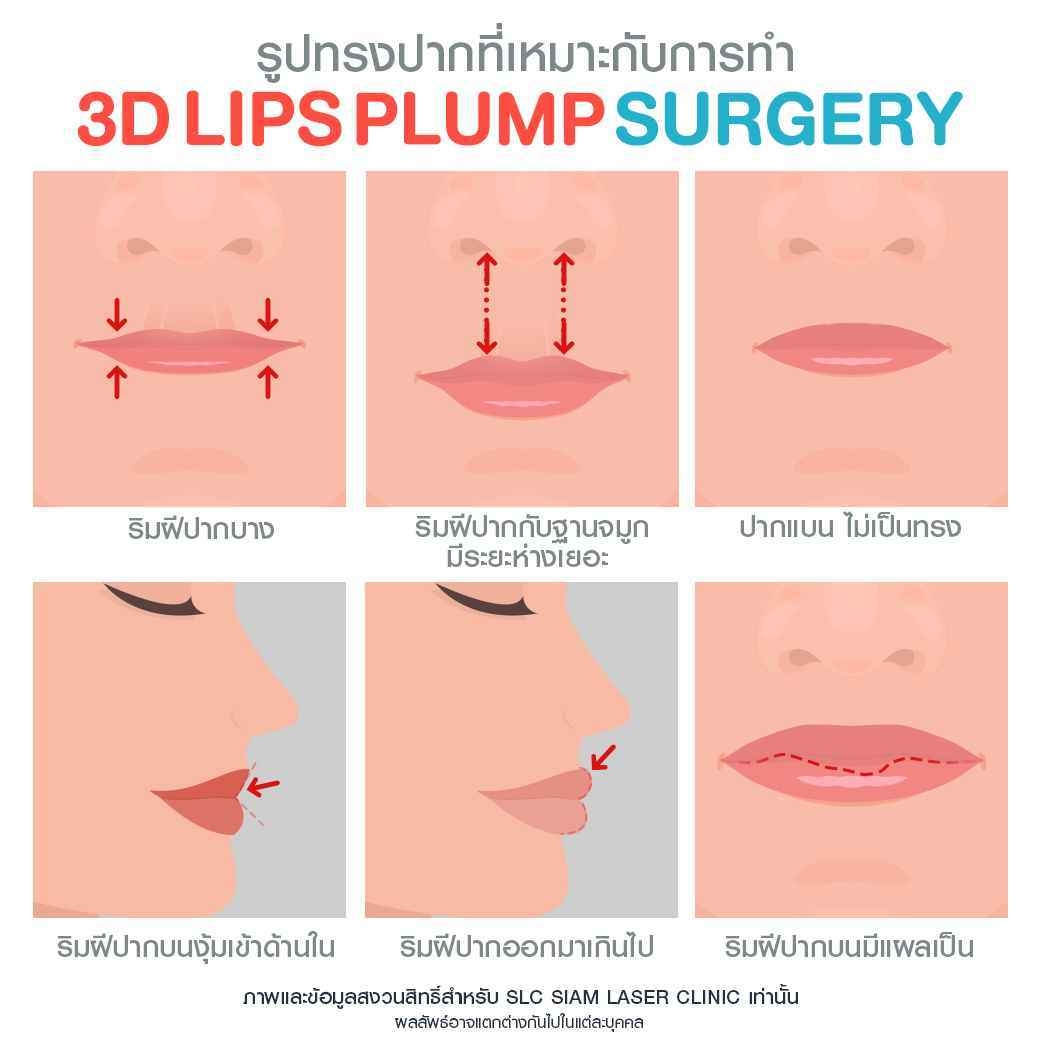 ปากฟู,3D Lips Plump Surgery , ปั้นปากสวย